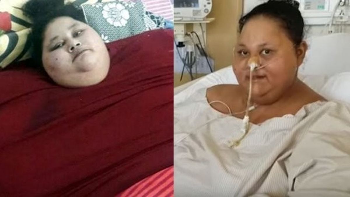 La Mujer M S Obesa Del Mundo Pierde Kilos Tras Una Operaci N