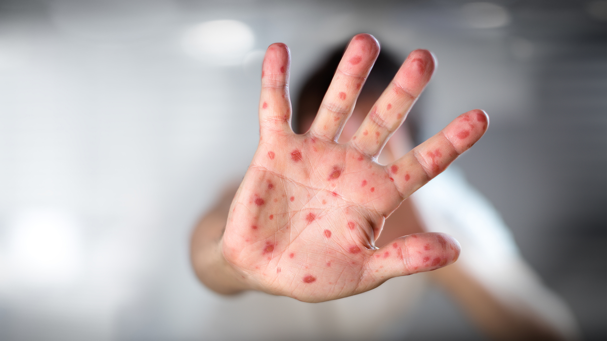 Viruela símica: EEUU realiza ensayos clínicos de una vacuna