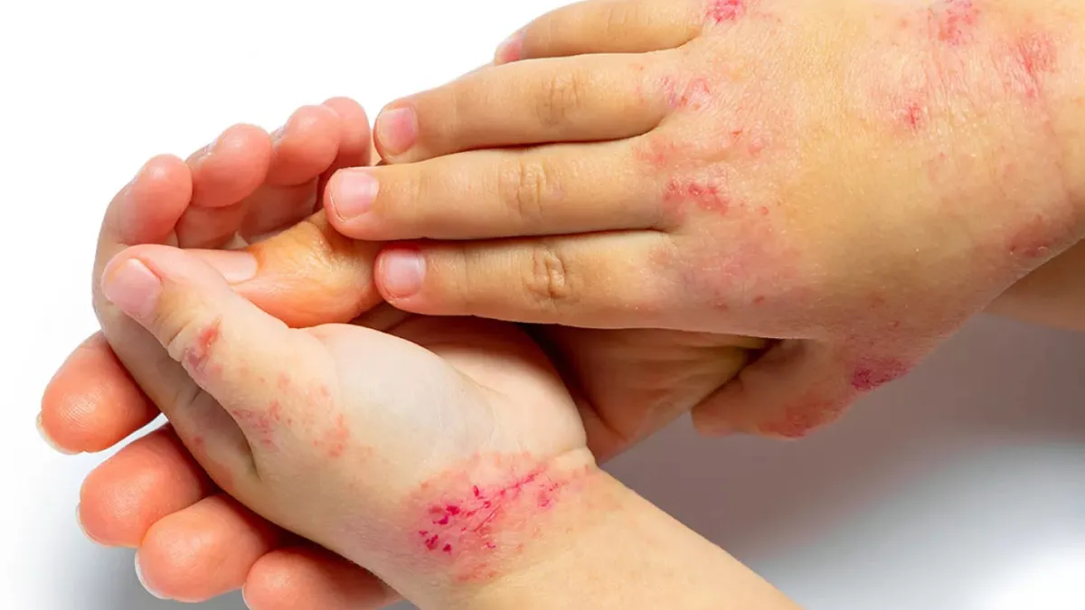 Campaña de detección gratuita de dermatitis atópica: cómo pedir turno