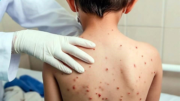 Sarampión: por un nuevo caso encienden las alarmas sanitarias en Argentina