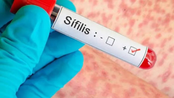 Argentina registra un récord histórico de sífilis