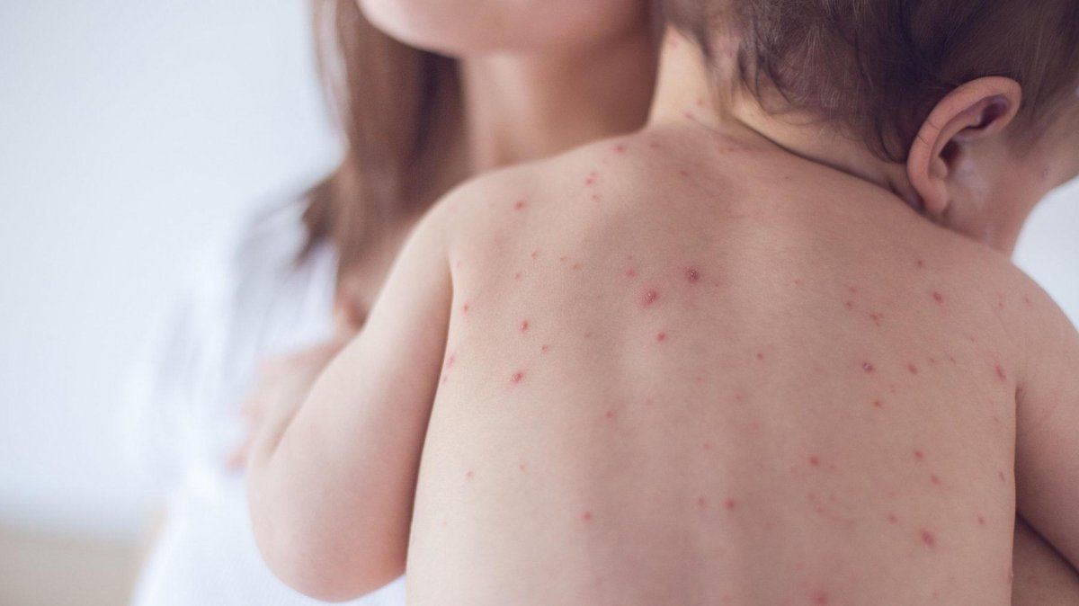Los niños entre 12 meses y 4 años deben acreditar una dosis de vacuna triple viral.