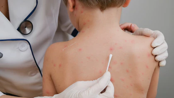 Sarampión: Monitorean a 98 contactos estrechos que pudieron haber estado expuestos