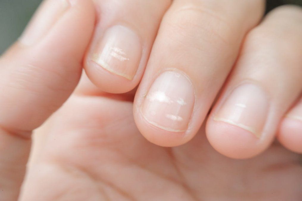 ¿Es verdad que las manchitas blancas de las uñas son por falta de calcio?